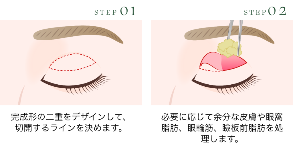 二重切開法とは