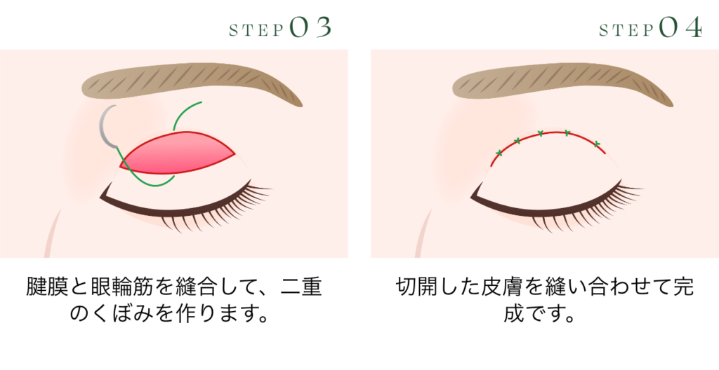 二重切開法とは
