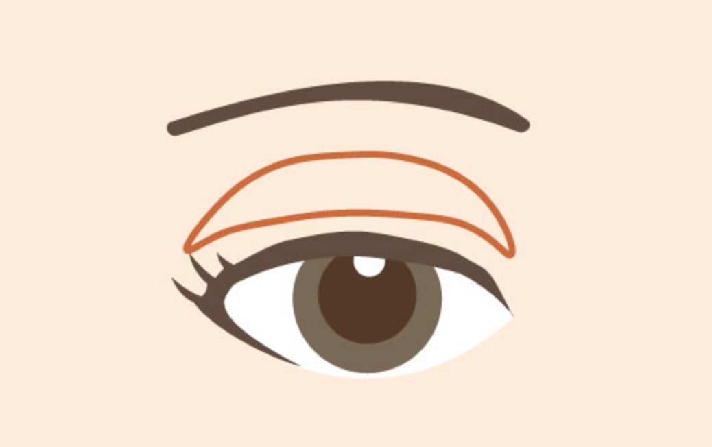 眼瞼下垂(眼瞼挙筋前転術)