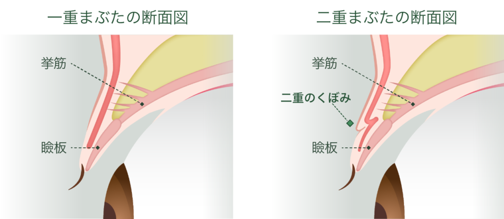 二重整形 埋没法とは