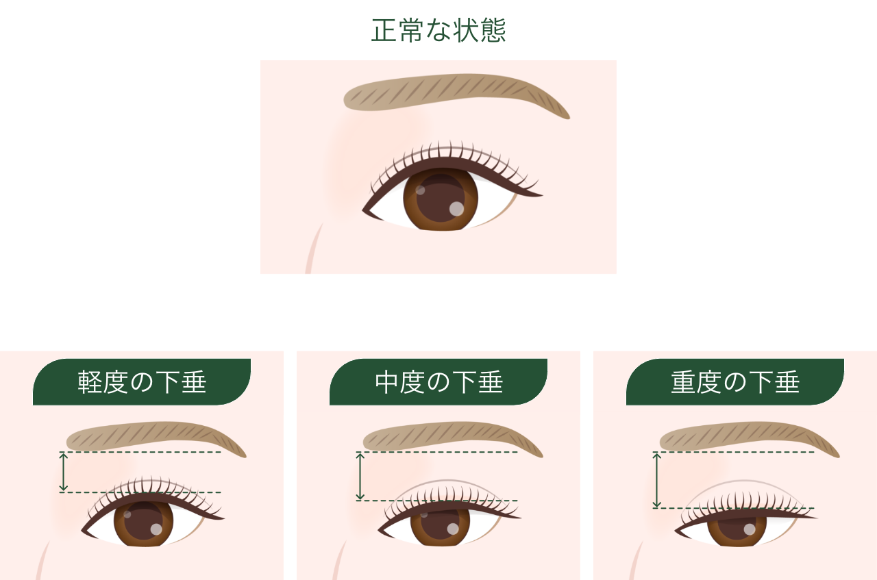 													眼瞼下垂（眼瞼挙筋前転術）																									