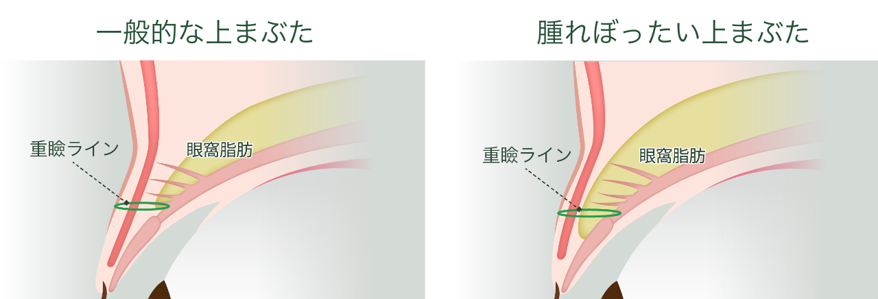 瞼の腫れぼったさの原因