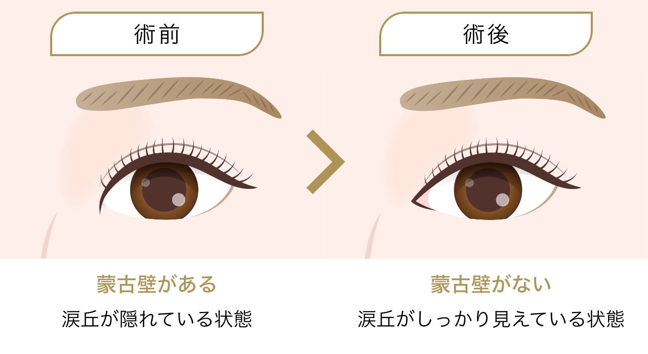 目頭切開のメリット 目が大きくなる