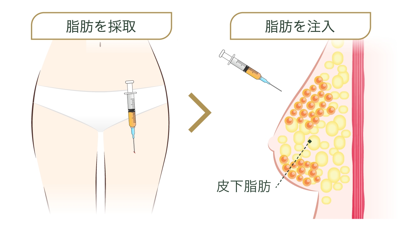 豊胸術・脂肪幹細胞注入とは