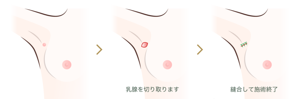 副乳除去とは