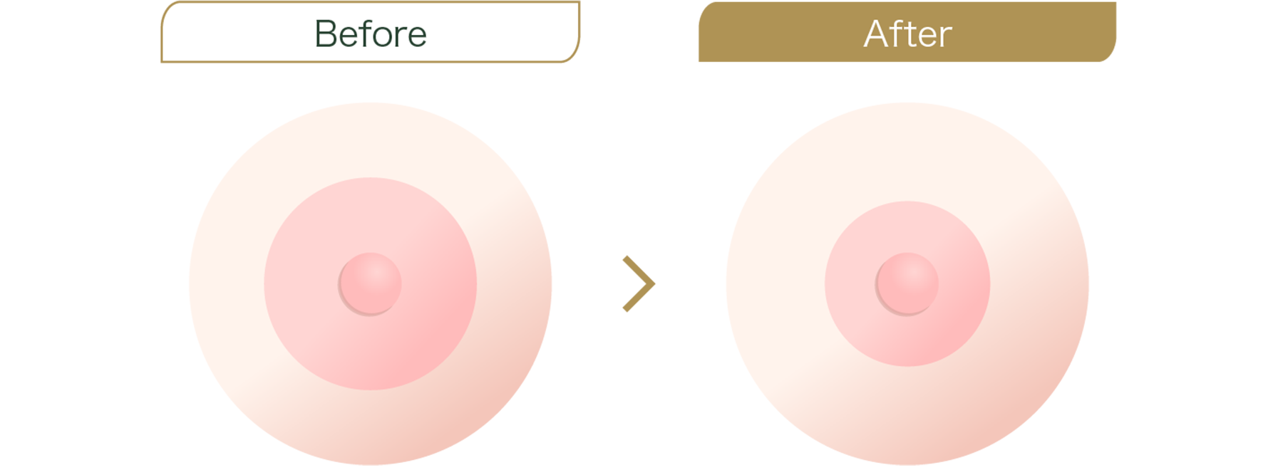 乳輪を小さくする・乳輪縮小術とは