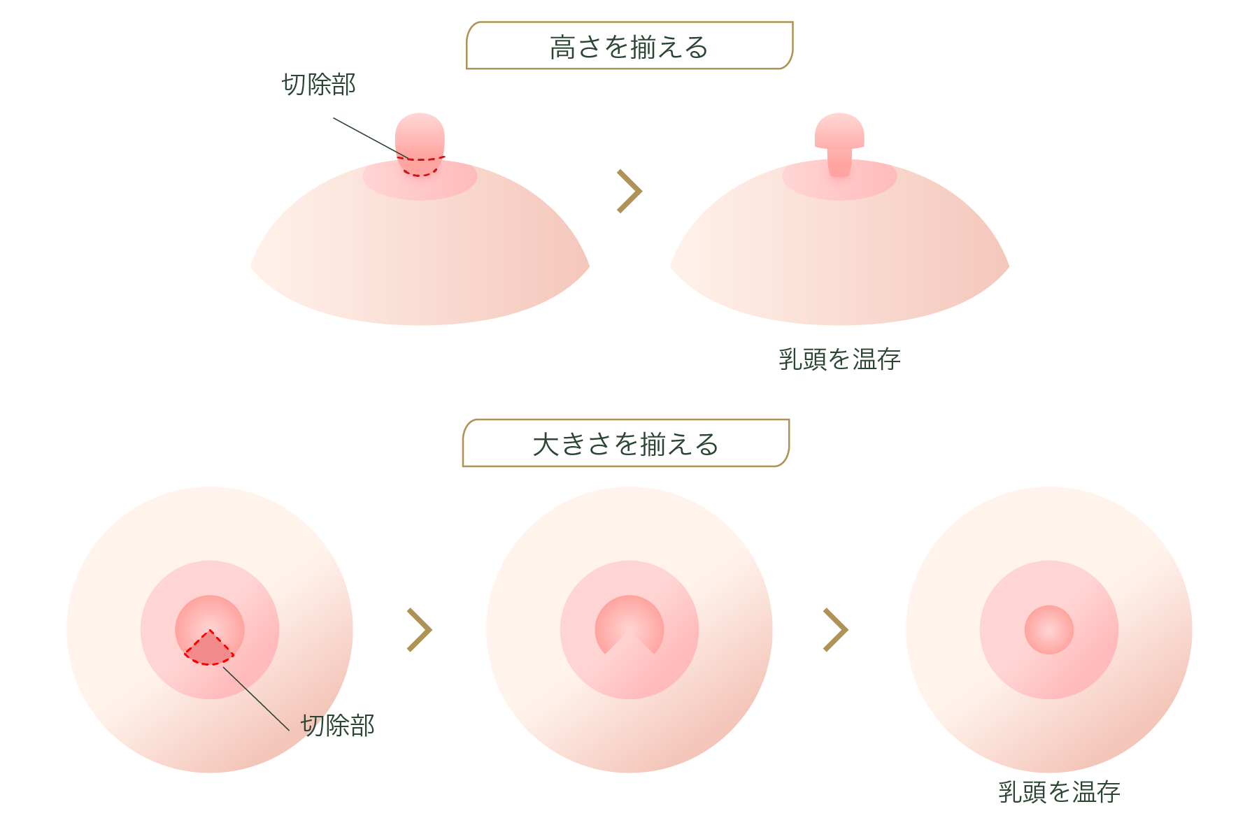 乳首を小さくする・乳頭縮小術とは