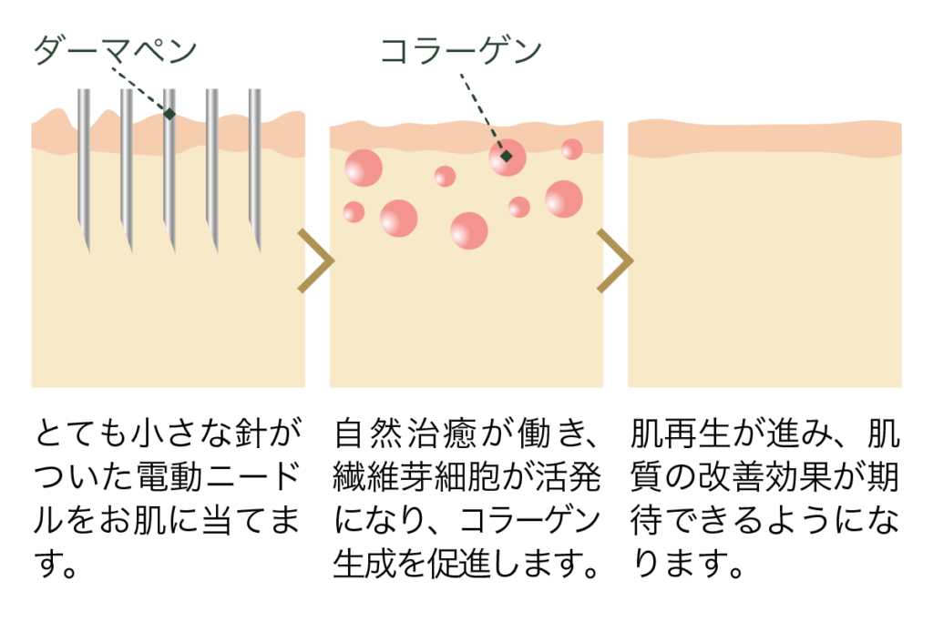 ダーマペンの仕組み