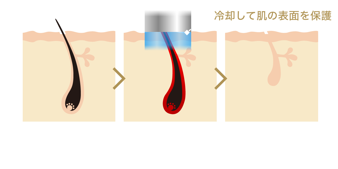 医療脱毛の仕組み