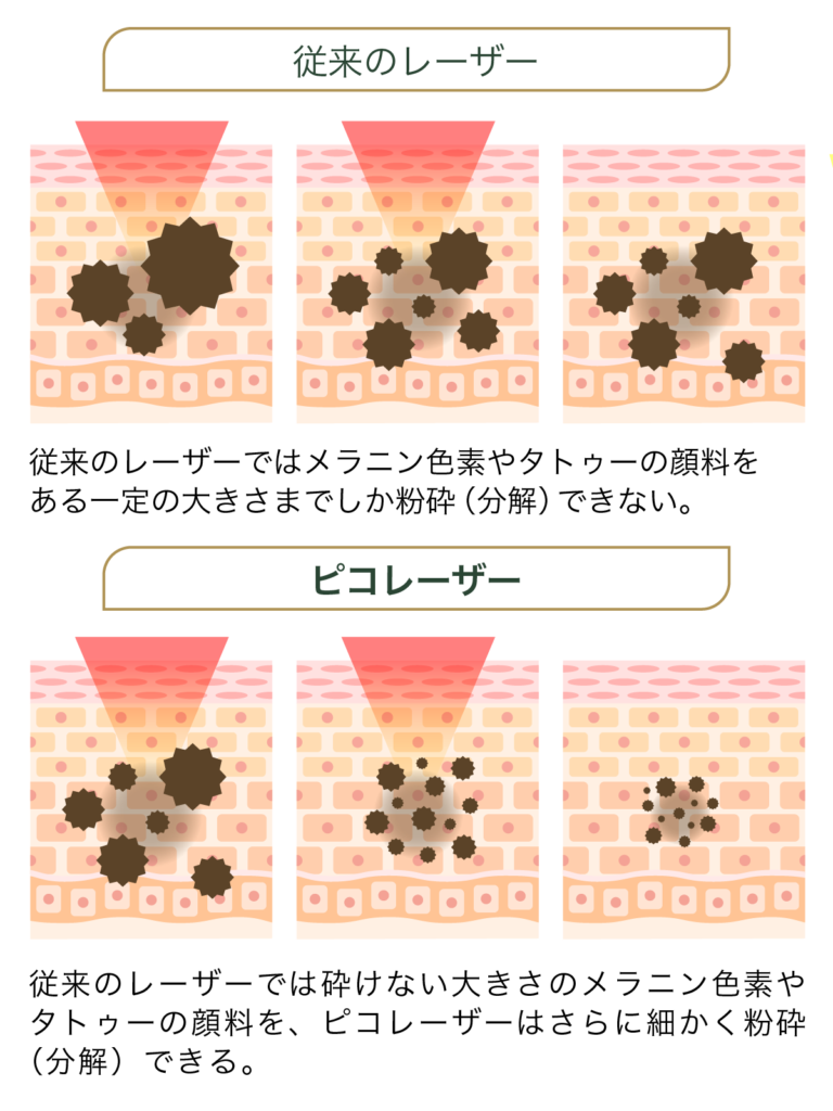従来のピコレーザーとの違いとは？