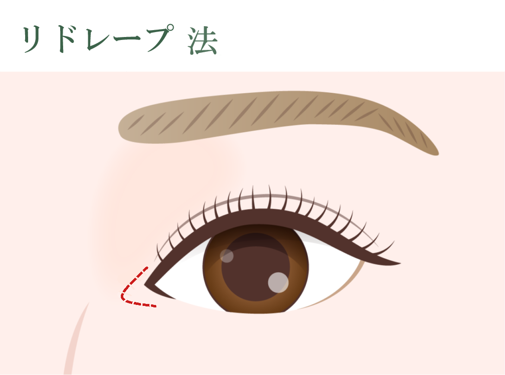 リドレープ法 下に伸びる蒙古襞の方におすすめの方法です。																																		
