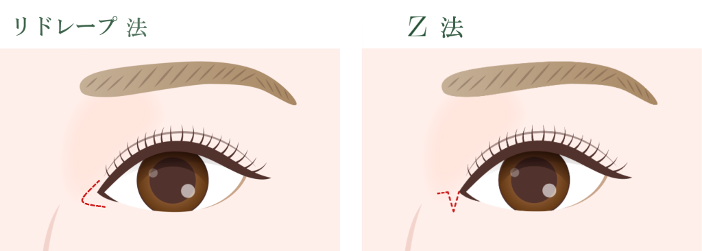 目頭切開とは