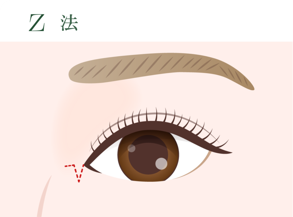 Z法　目頭を広げて尖らせるような平行二重に適しています。幅広い形状に適応性があります。