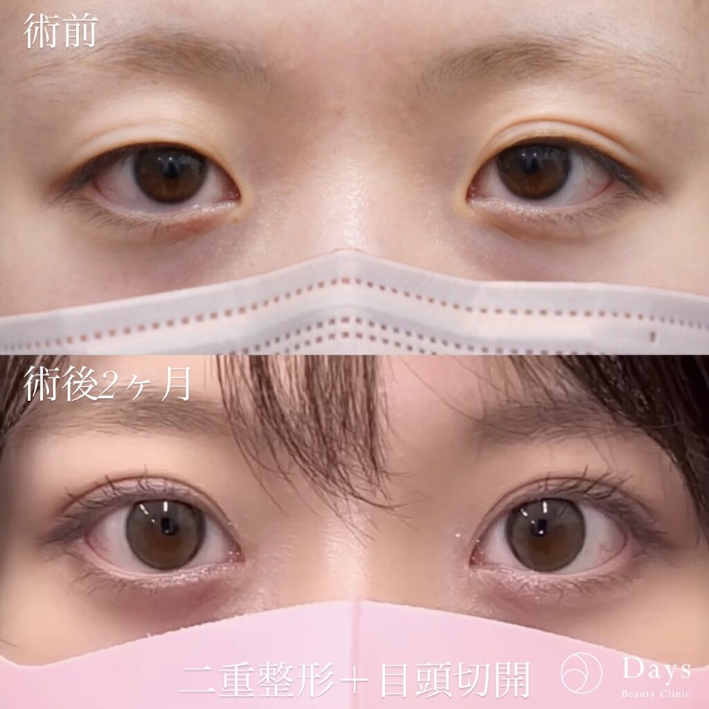 二重整形の症例写真