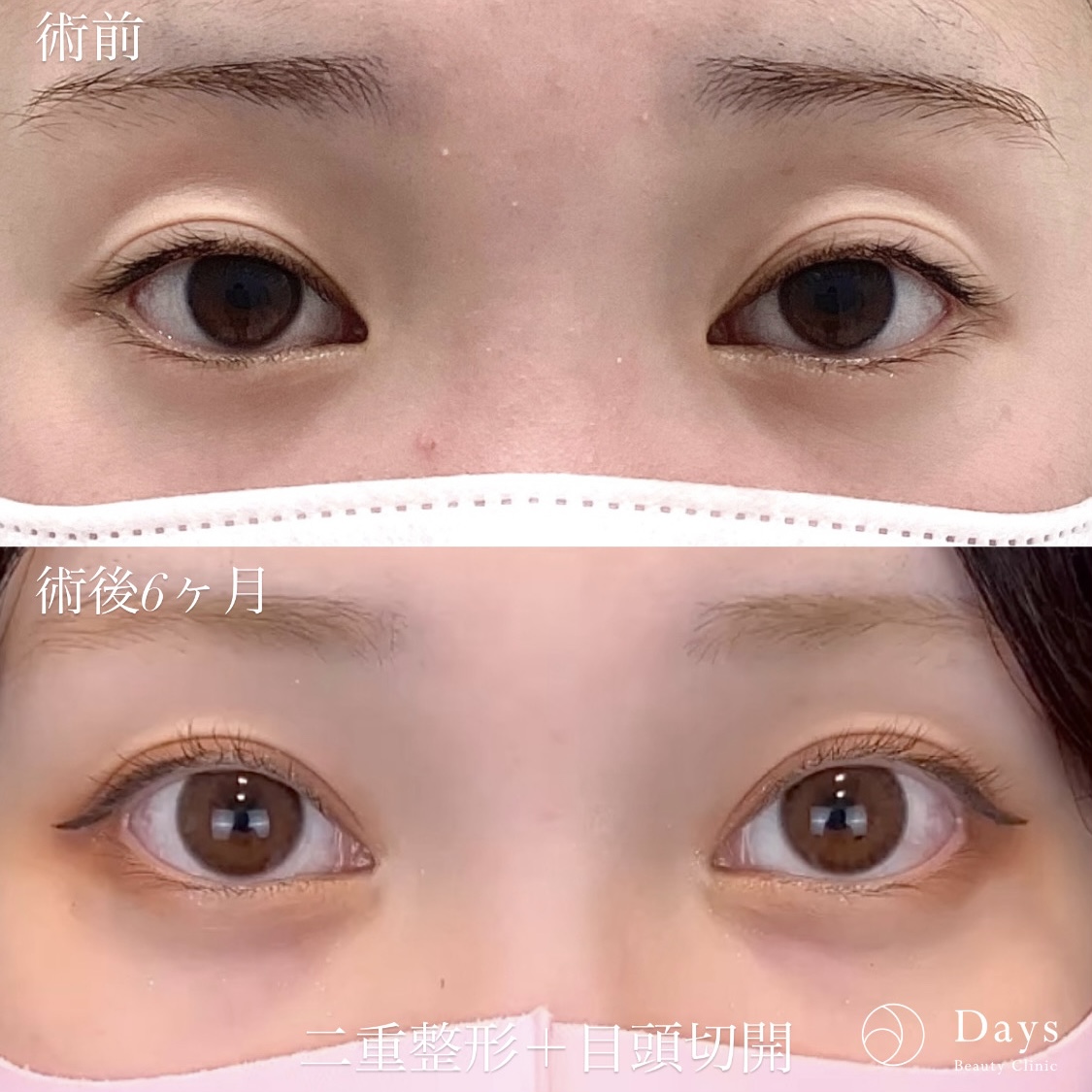 二重整形の症例写真