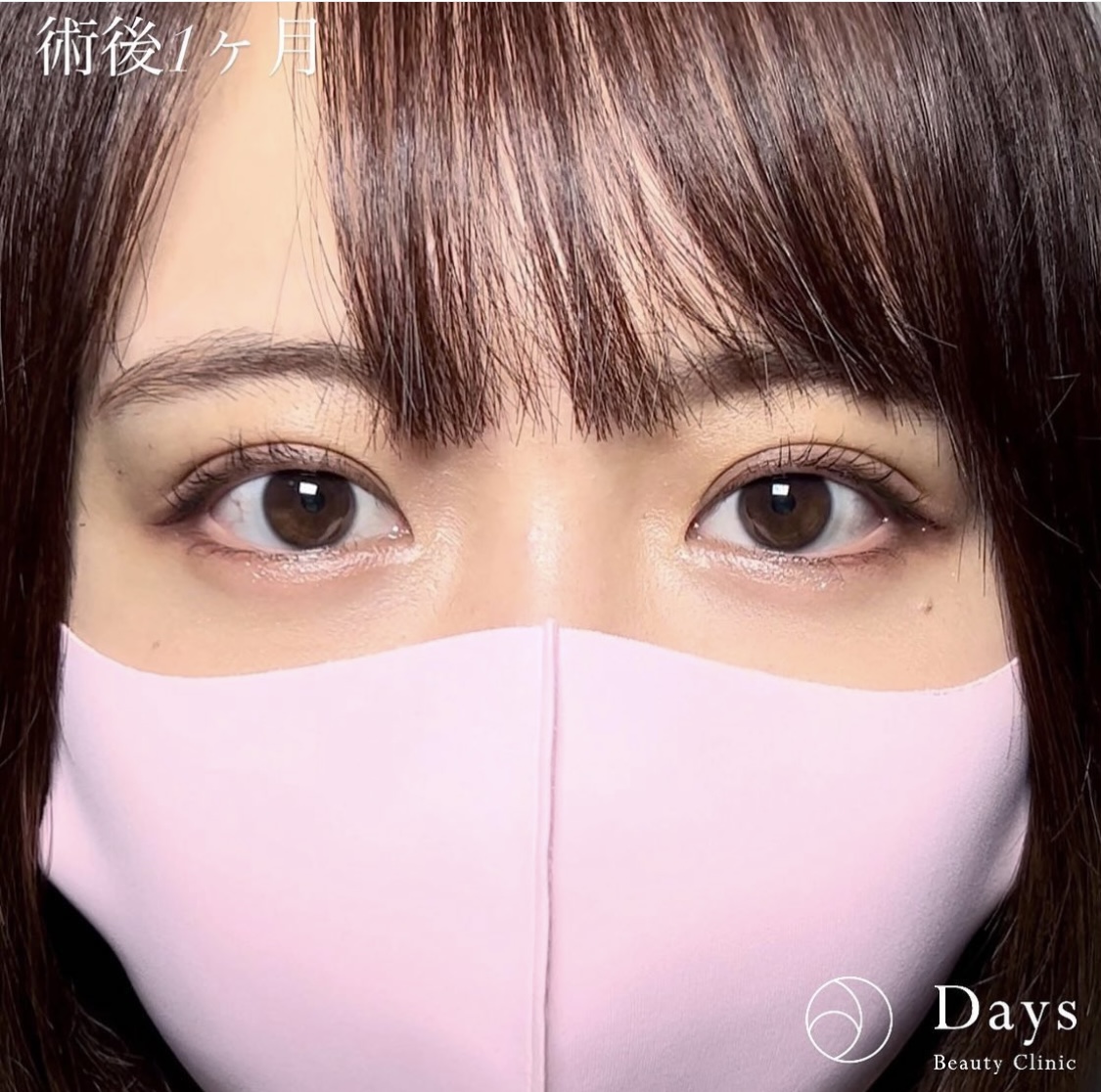 二重埋没法の症例写真