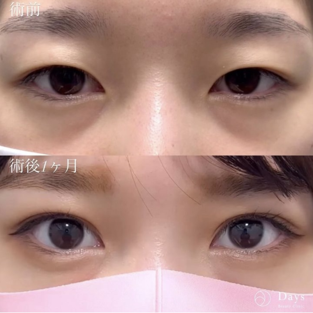 二重整形の症例写真