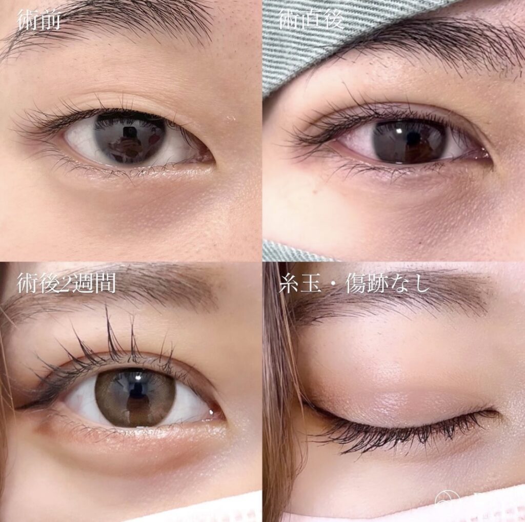 二重整形の症例写真
