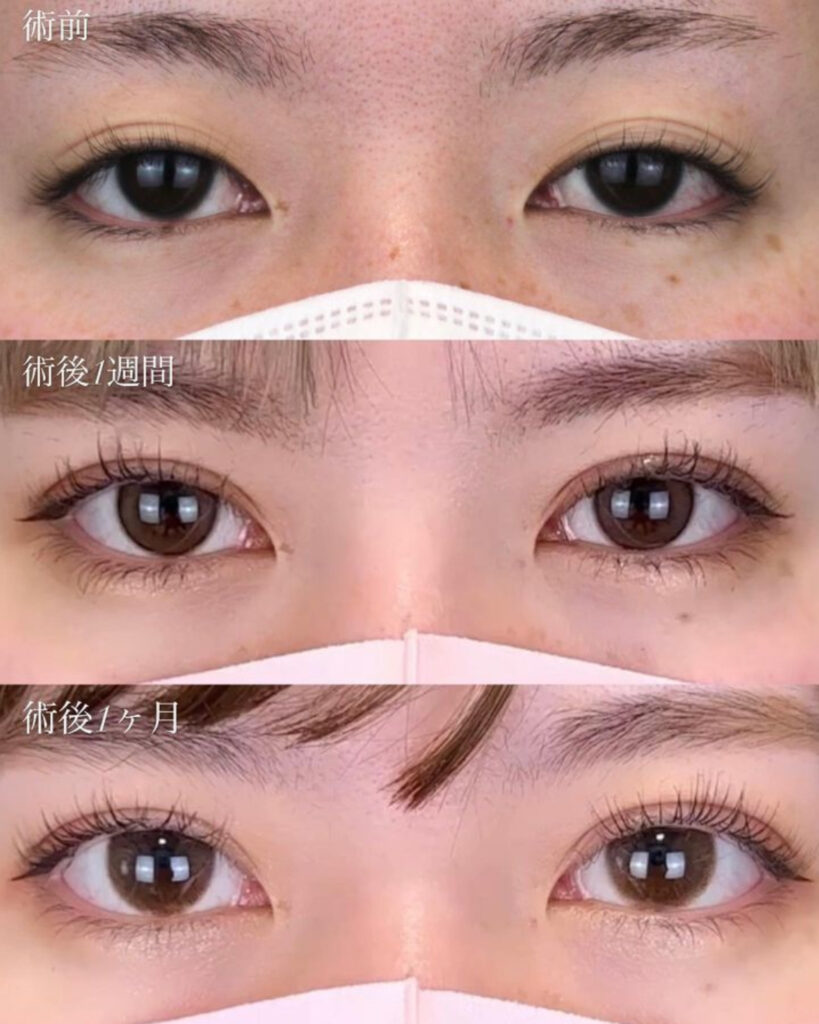 二重埋没法の症例写真