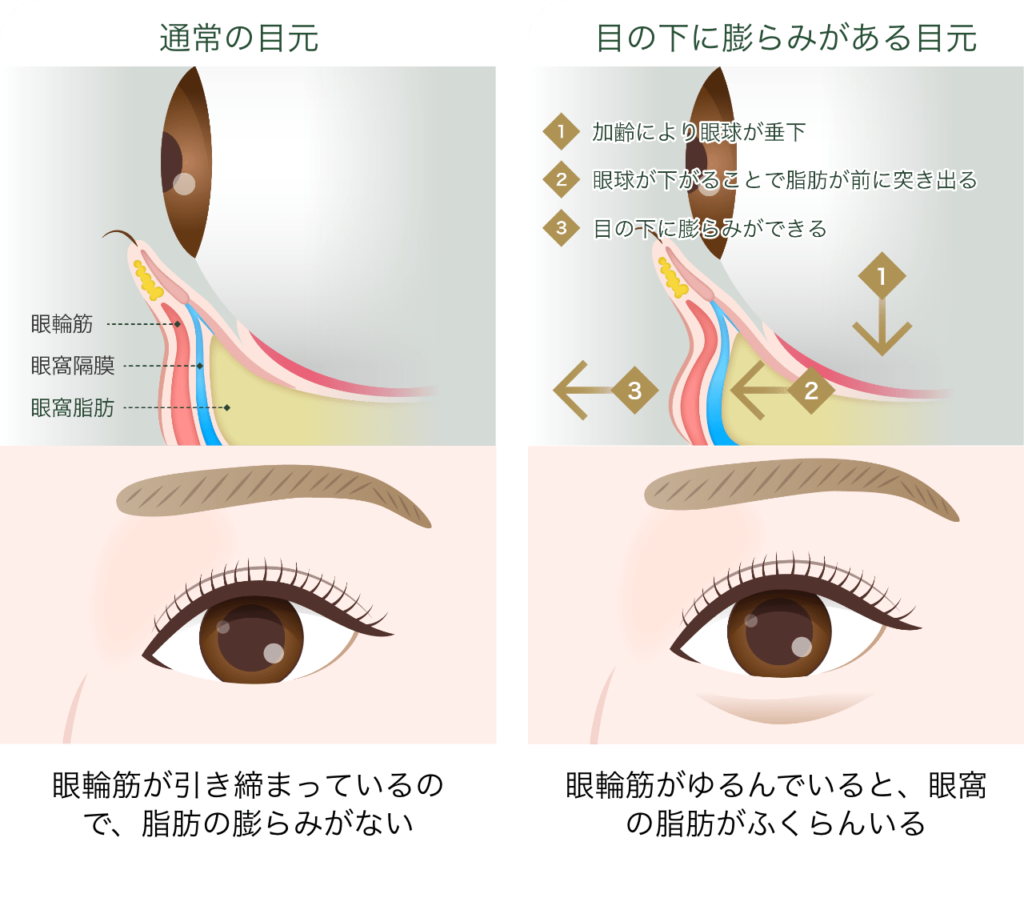 目の下の切らない クマ・たるみ(ふくらみ)取りとは