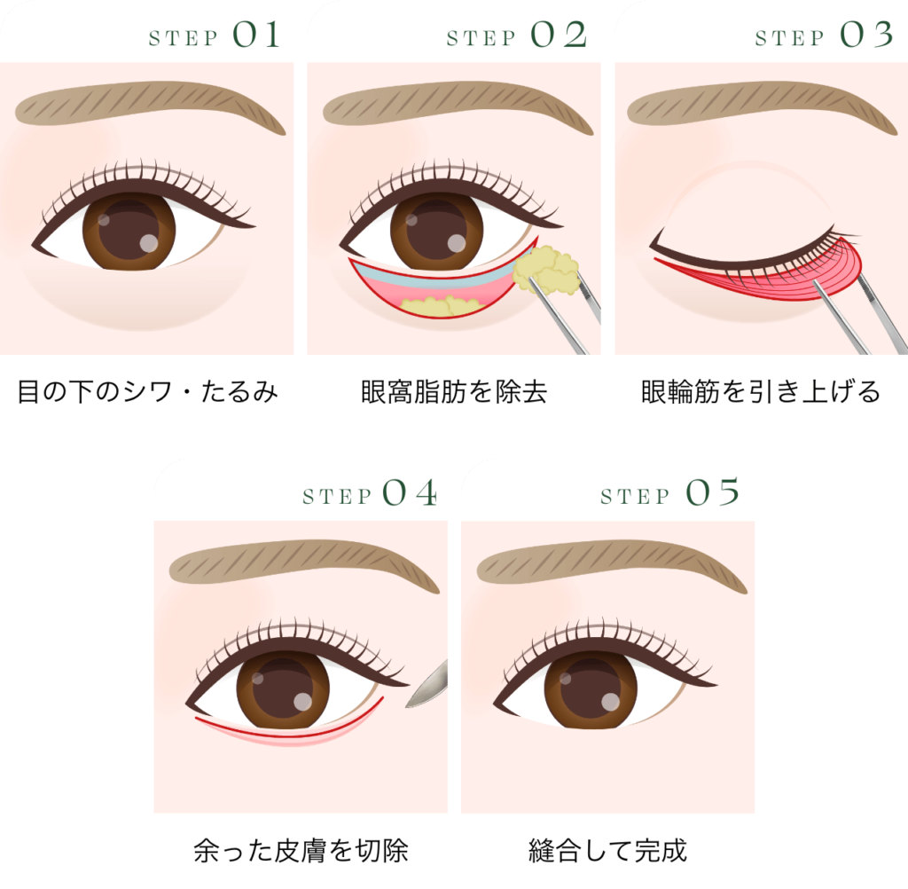 切開法による目の下のたるみ取り(下眼瞼除皺術)の施術方法