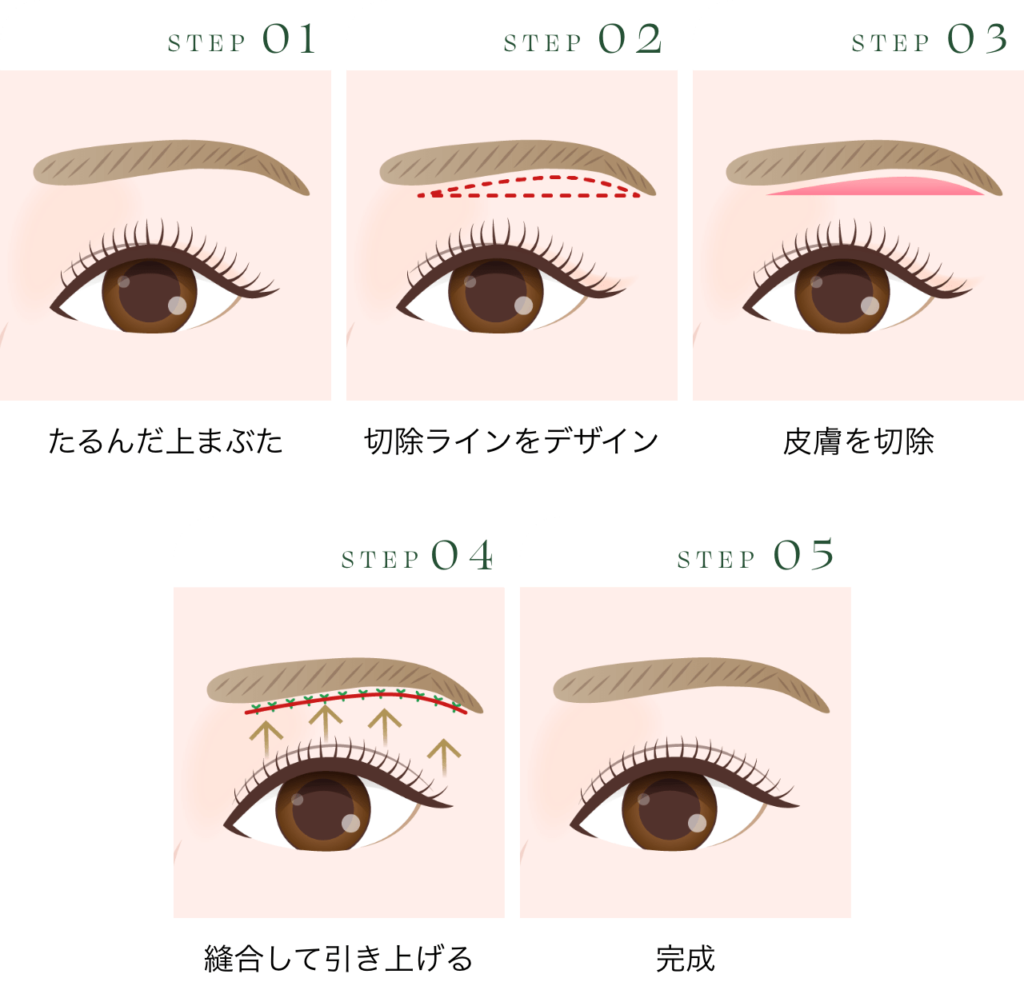 眉下リフトの特徴