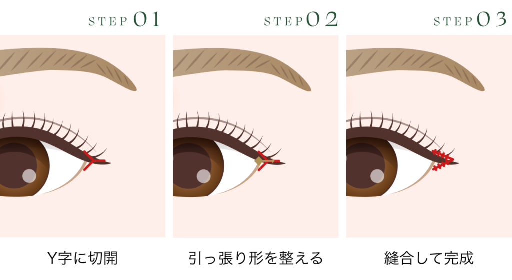 目尻切開 V-Y flap法