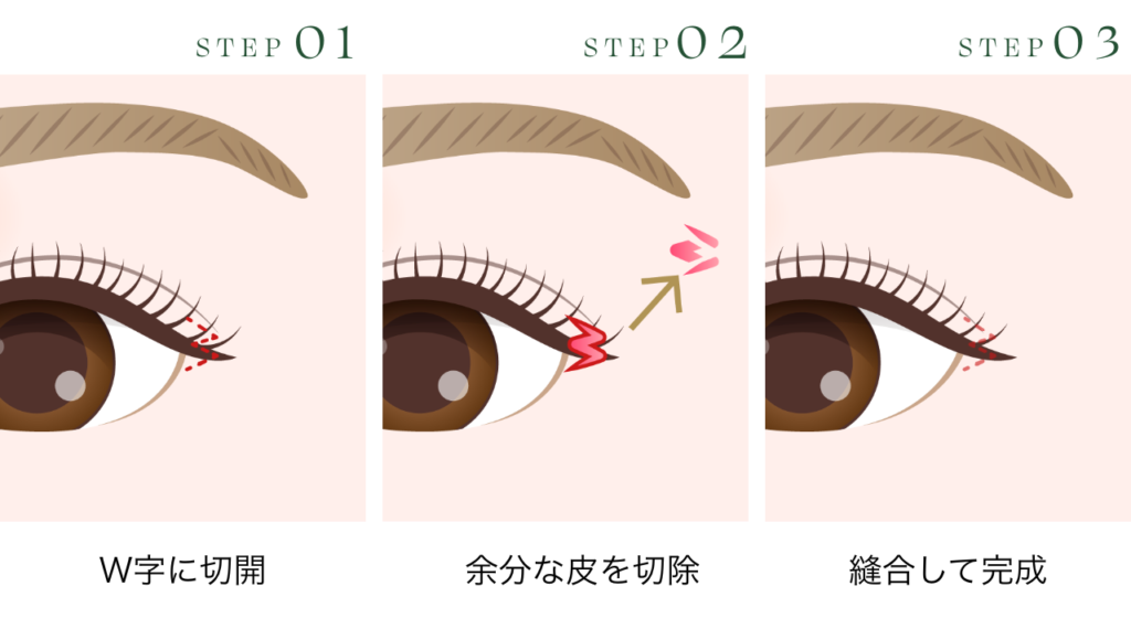 目尻切開 W法