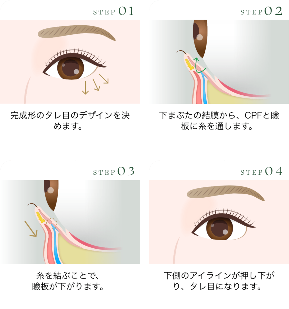 グラマラスライン形成 切らないタレ目形成（埋没法・タッキング）