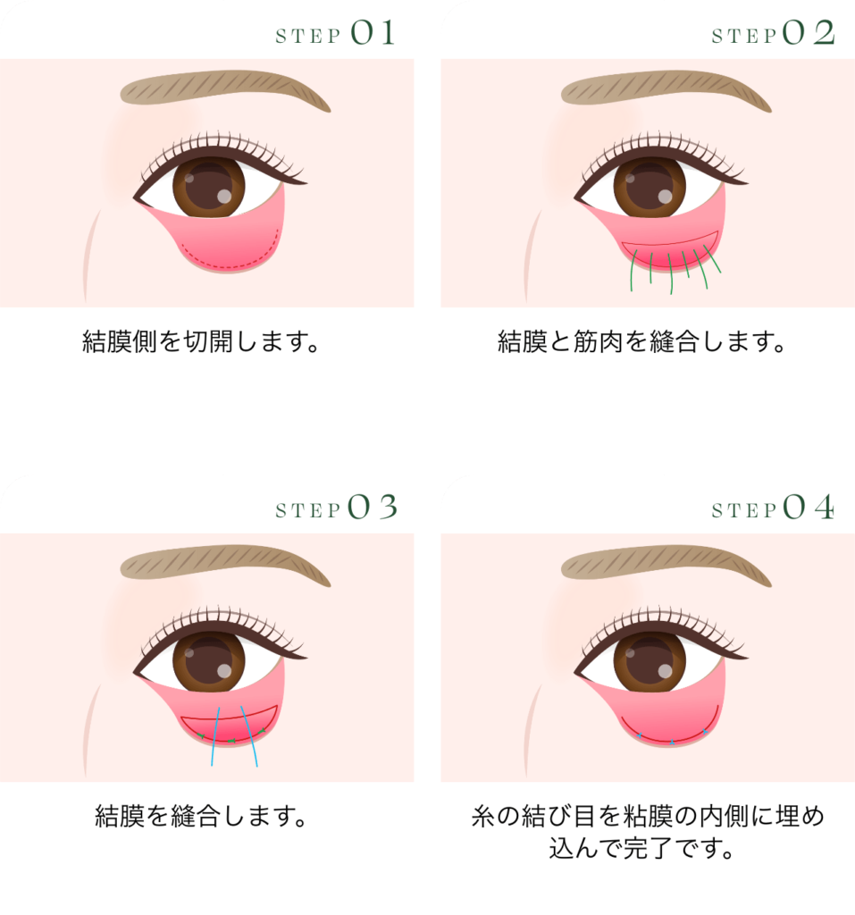 グラマラスライン形成 切らないタレ目形成（結膜切開）