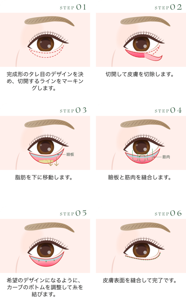 グラマラスライン形成 切るタレ目形成（皮膚切開）