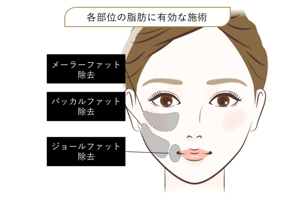 バッカルファット除去とは