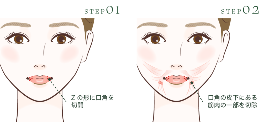 下口唇に一切切開線を作らないZ形成による口角挙上術 STEP1・2