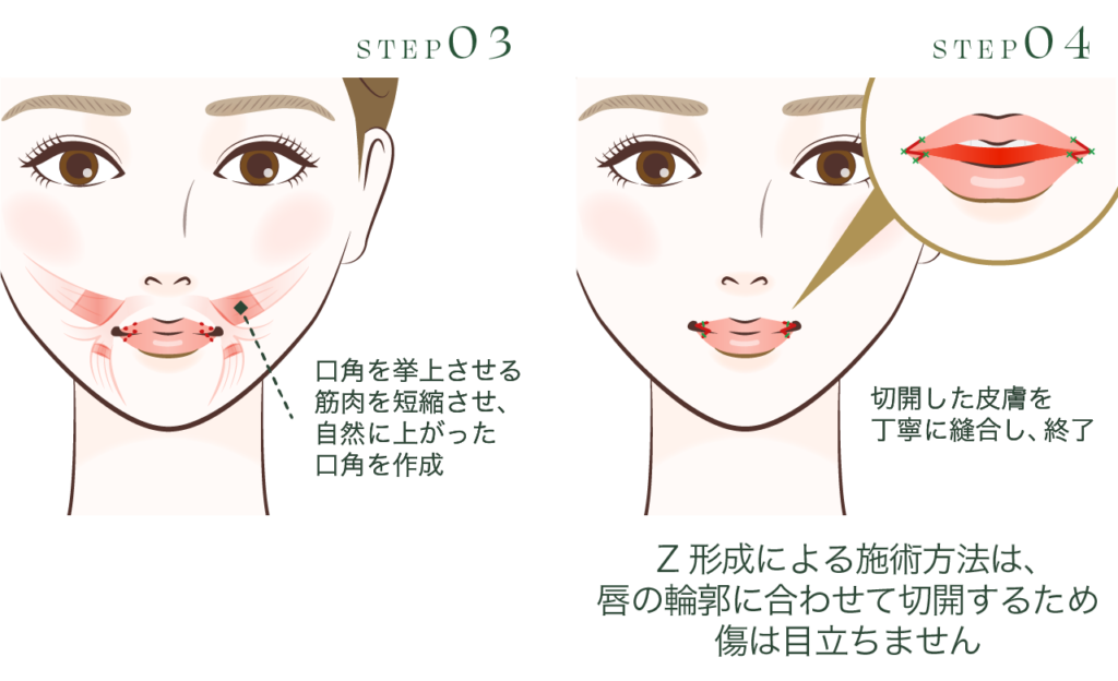 下口唇に一切切開線を作らないZ形成による口角挙上術 STEP3・4