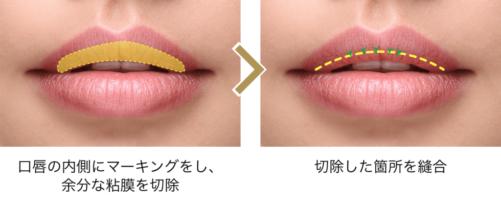 口唇縮小(スマートリップ)とは