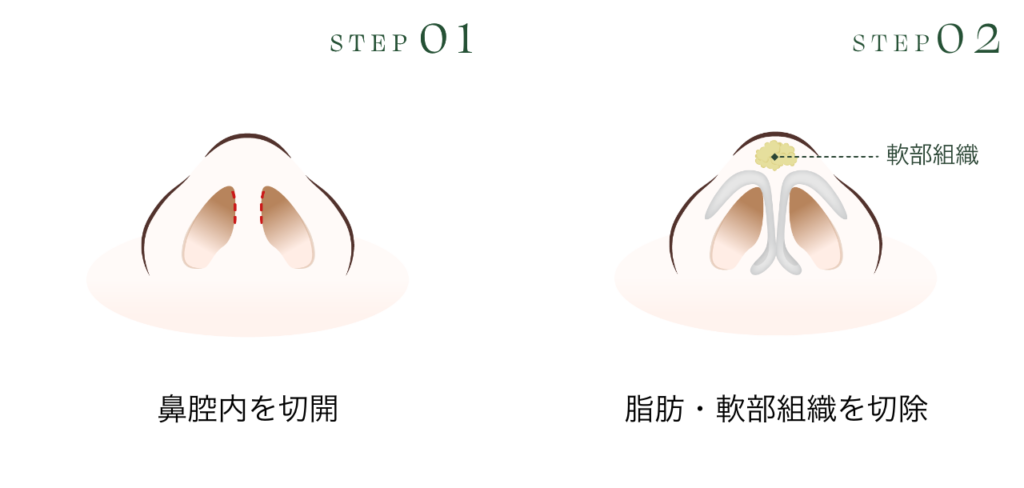 クローズ法
