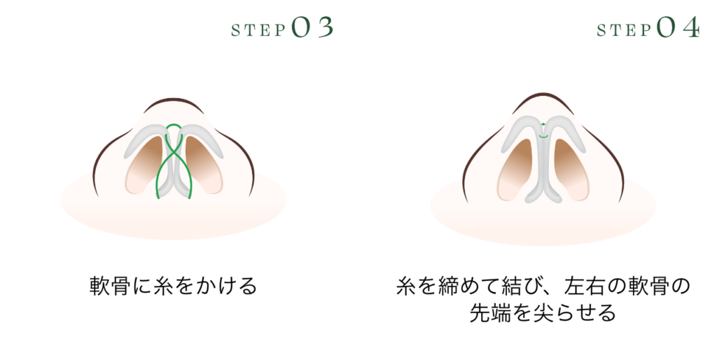 クローズ法
