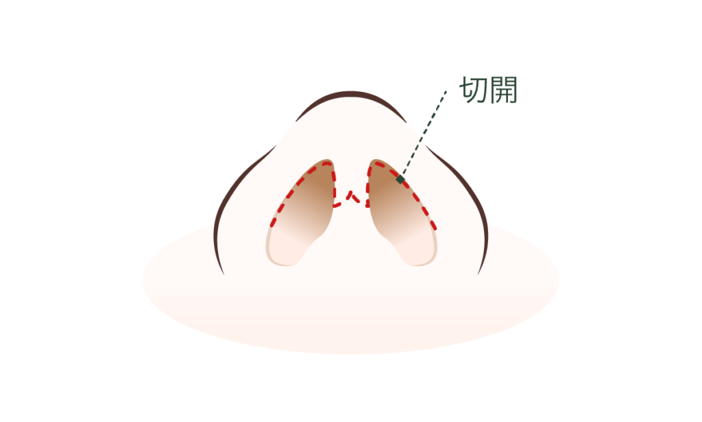 鼻中隔延長の施術方法