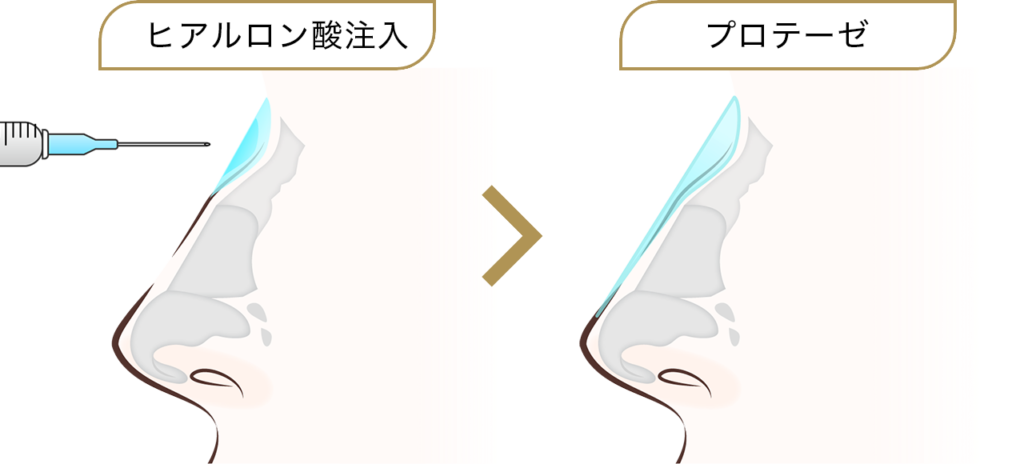 わし鼻修正の施術の特徴