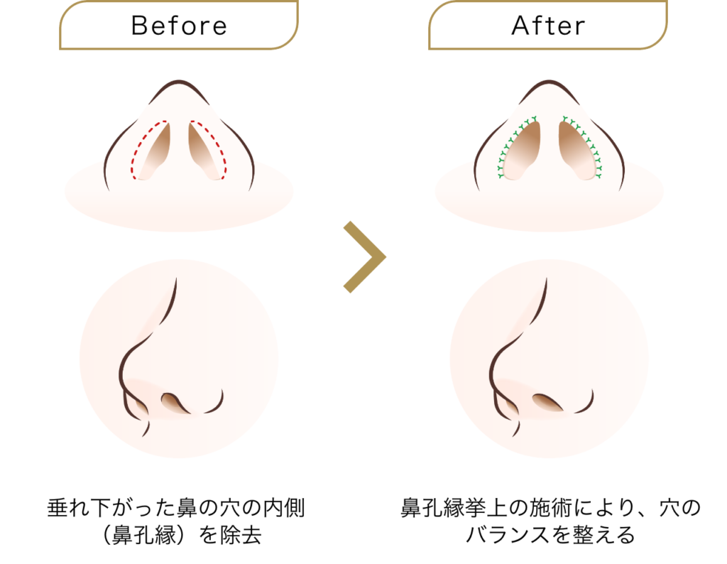 鼻孔縁挙上とは