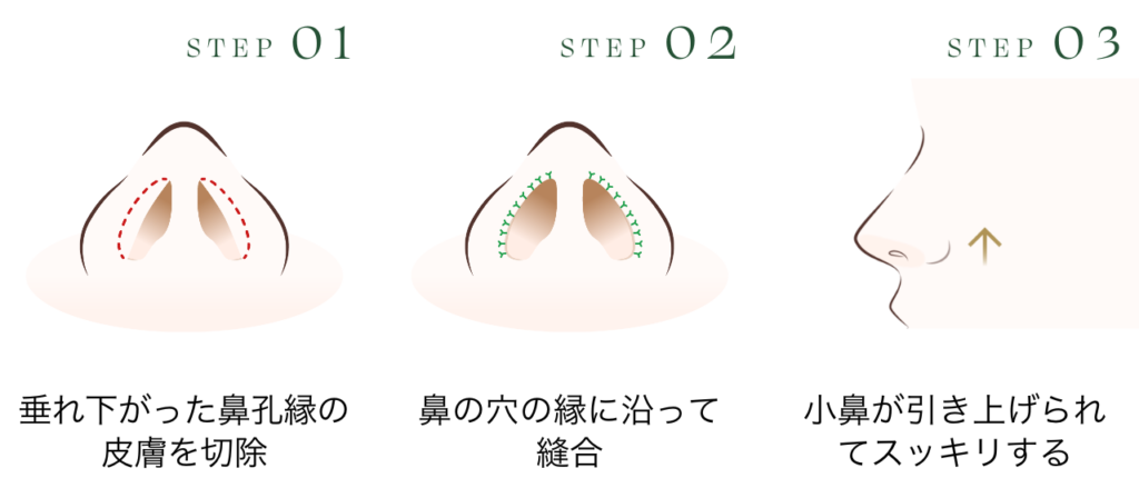 鼻孔縁挙上の施術方法