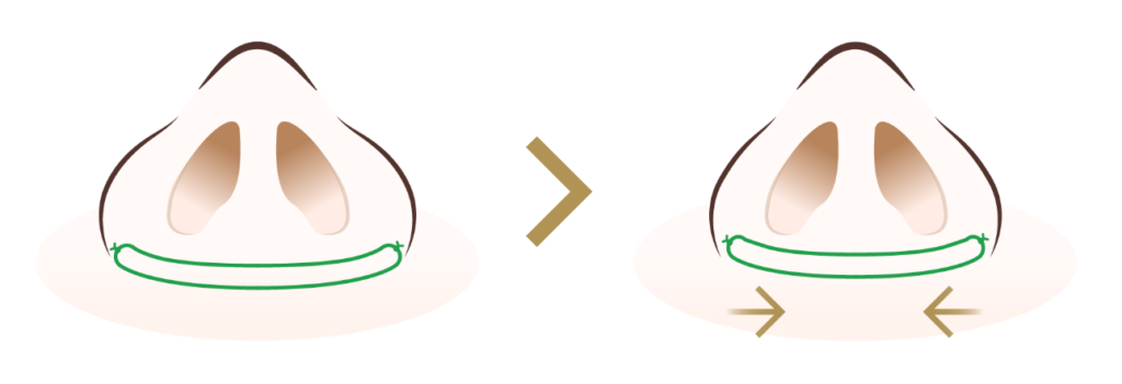 切らない小鼻縮小