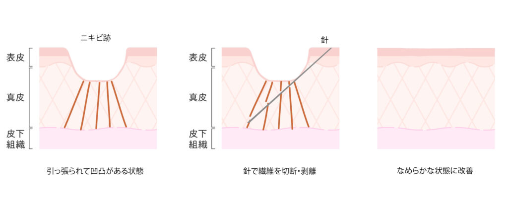 ニキビ跡 引っ張られて凹凸がある状態 針で繊維を切断・剥離 なめらかな状態に改善