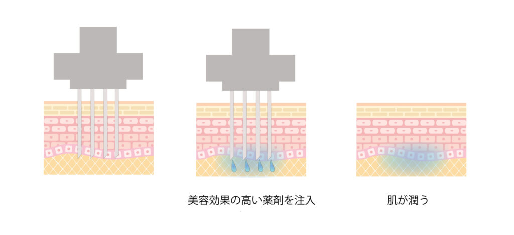 美容効果の高い薬剤を注入　肌が潤う