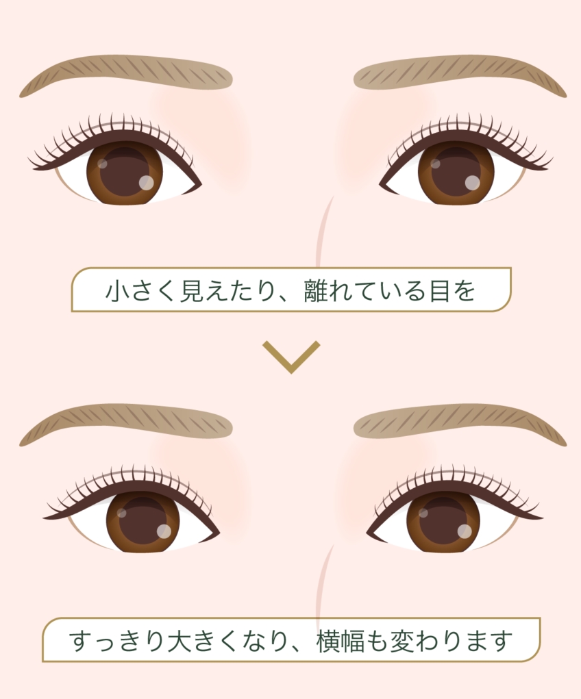 目尻切開とは