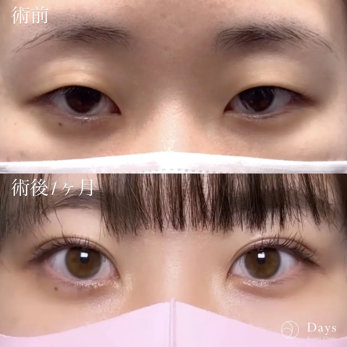 ミックス型二重整形の症例写真