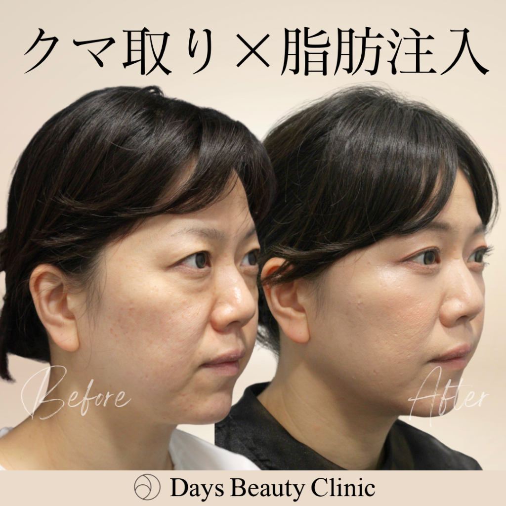 目の下のクマ取り/脂肪注入