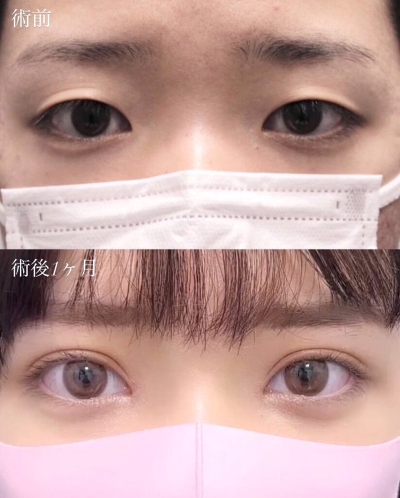 二重整形 埋没法 目頭切開
