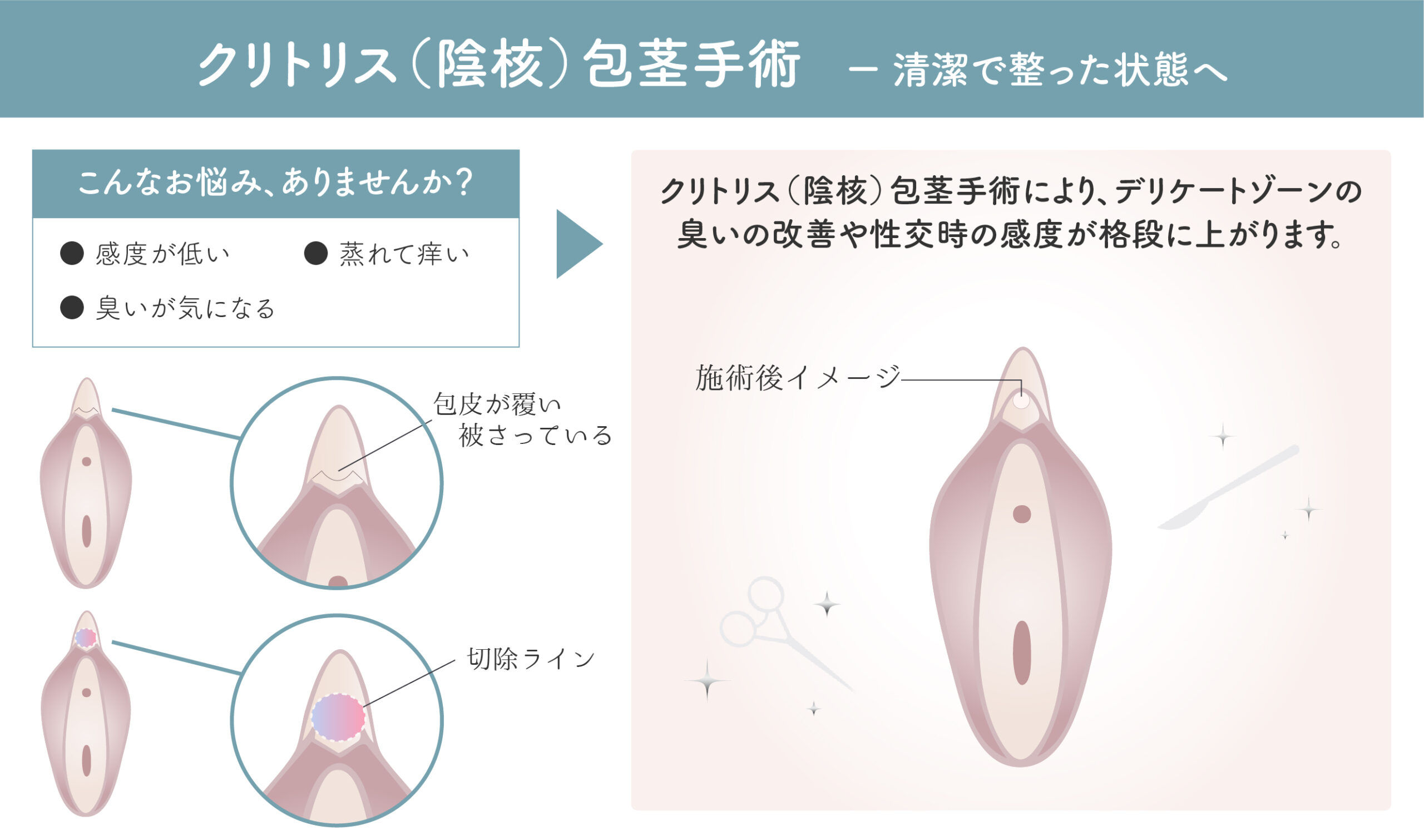 クリトリス（陰核）包茎手術イメージ