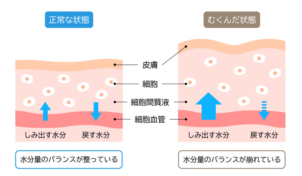 正常な状態とむくんだ状態の皮膚